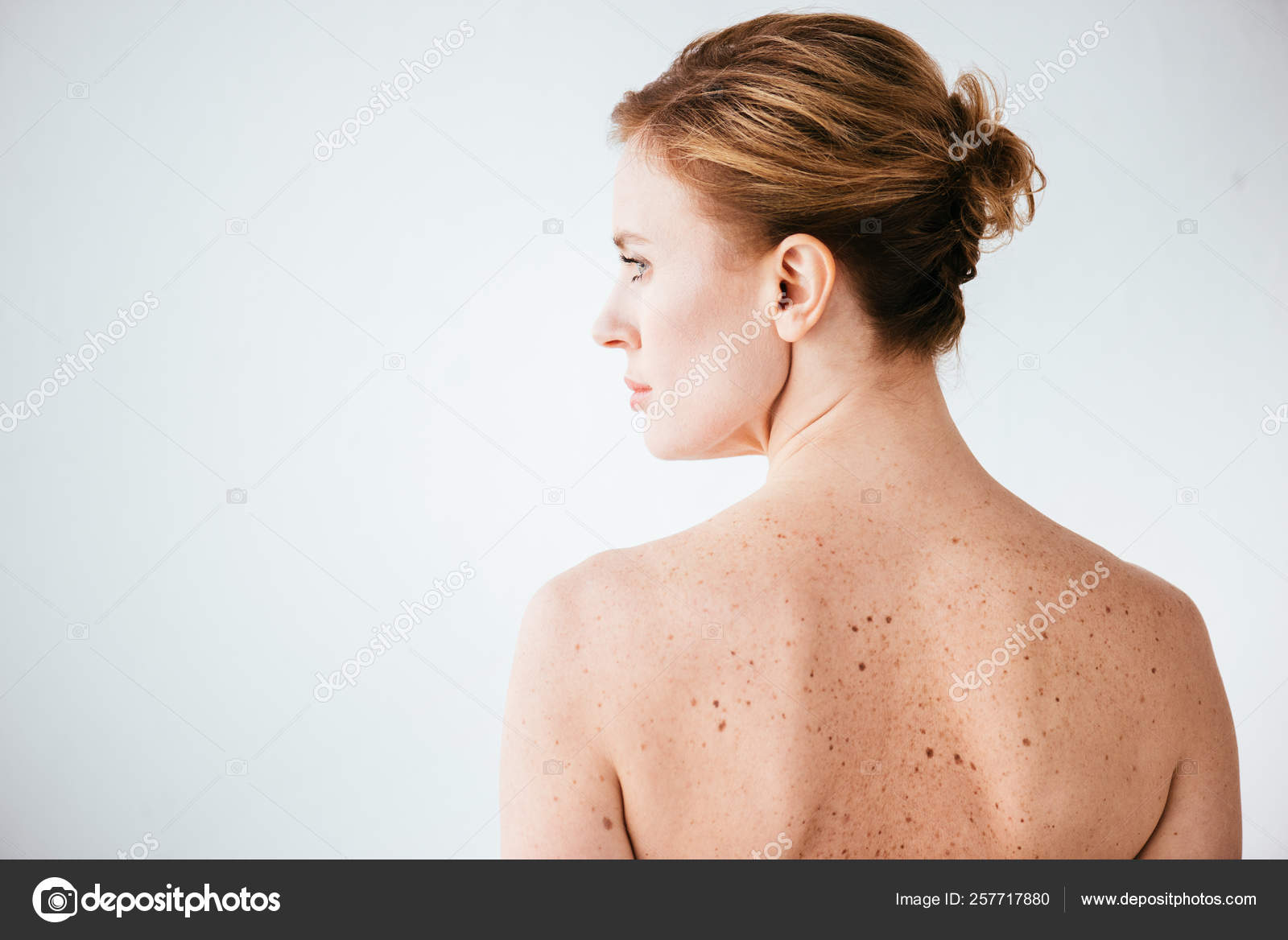 Attractive Naked Woman Skin Sickness White Stock Photo By
