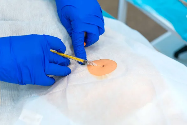 Close Surgeon Burns Mole Back Patient Mole Removal Surgery Procedure — Stock Photo, Image