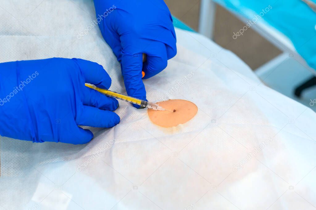 Close-up surgeon burns a mole on the back of the patient. Mole Removal Surgery Procedure.