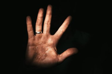 Eli nasırlı bir işçi protestolara katılıyor. Dur!