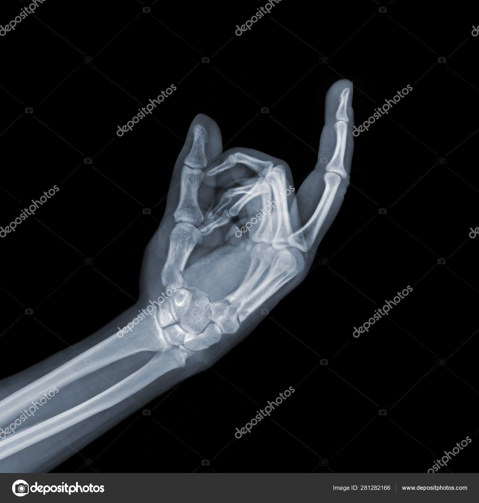 X-ray hand showing a middle finger sign Stock Photo by ©eAlisa 281282166