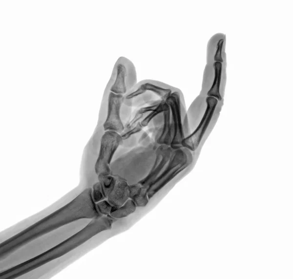 Raio-X mão mostrando um sinal do dedo médio — Fotografia de Stock