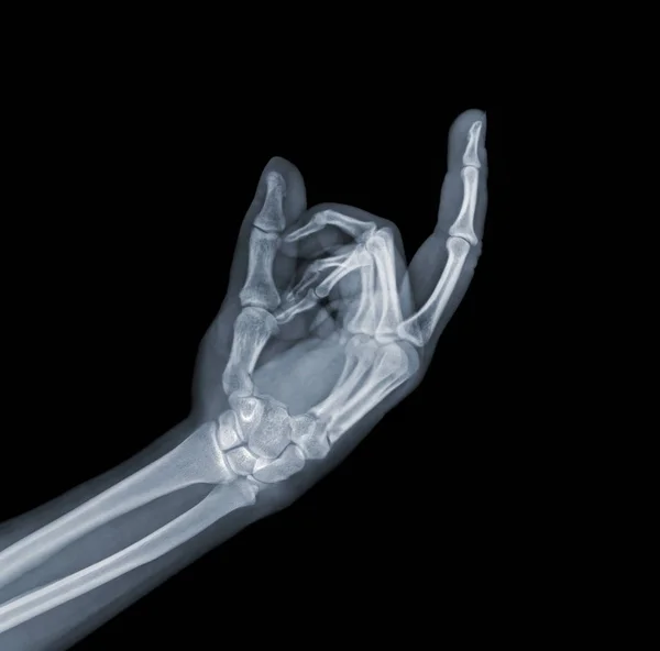 Raio-X mão mostrando um sinal do dedo médio — Fotografia de Stock