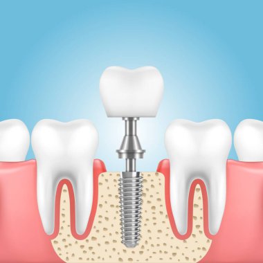 Diş implantı, diş protezi teknolojisi.