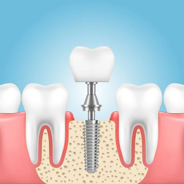 Імплантація зубів, технологія стоматології — стоковий вектор