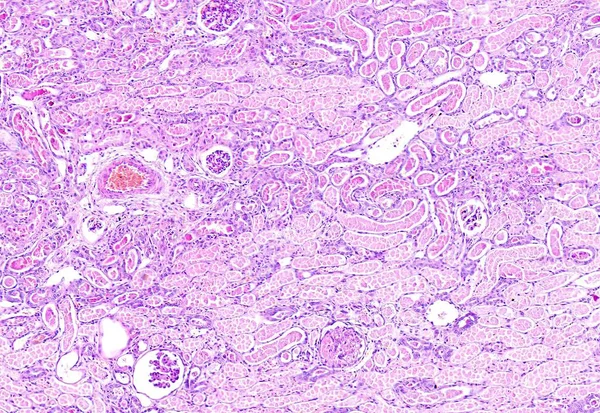 Histologia do tecido humano, mostram necrose cortical do rim como visto sob o microscópio, zoom 10x — Fotografia de Stock