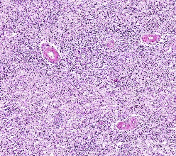 Гистология тканей человека, показывают дегенерацию селезенки гиалин центральной артерии, как видно под микроскопом, 10x зум — стоковое фото