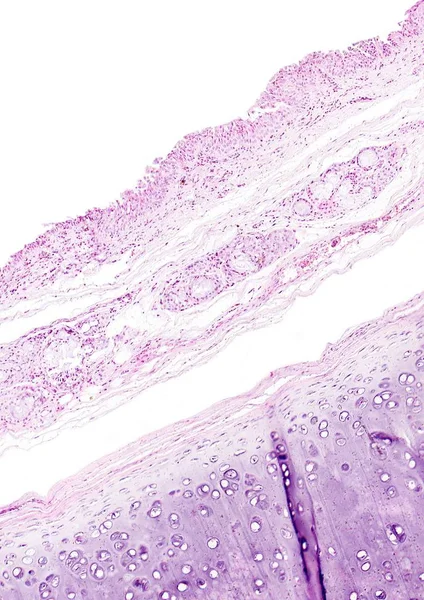 Histologia do tecido humano, mostrar traqueíte e metaplasia escamosa da mucosa brônquica como visto ao microscópio — Fotografia de Stock