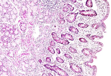 Histoloji insan dokusunun göster: Gastrik mukoza intestinal metaplazi mikroskop altında 10 x zoom görüldüğü gibi