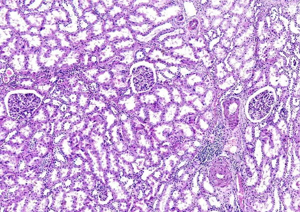 Histología del tejido humano, muestran degeneración hialina arteriolar del riñón como se ve bajo el microscopio, zoom 10x —  Fotos de Stock