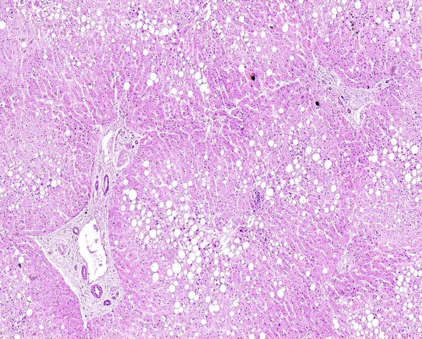 Histologia do tecido humano, mostram degeneração gordurosa do fígado como visto sob o microscópio, zoom 10x — Fotografia de Stock