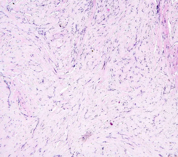 Pokaż histologicznego ludzkiej tkanki, tkanki łącznej, zwyrodnienie szkliste śledziony widziana pod mikroskopem, 10 x zoom — Zdjęcie stockowe