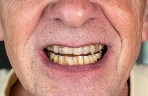 Starszy człowiek umieszczenie Straż nocna na krzywe zęby — Zdjęcie stockowe