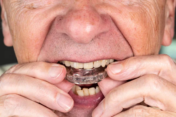 Senior man putting a night guard onto crooked teeth — Stock Photo, Image