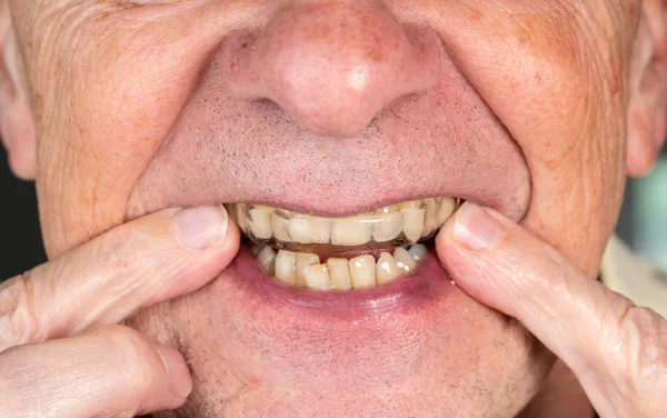 年配の男性が曲がっている歯に夜間警備員を置く — ストック写真