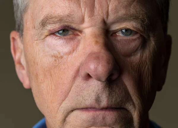 Senior caucasian man with a black eye — Stock Photo, Image