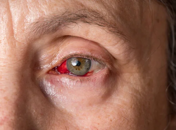 Tett i øyet hos eldre kvinner med konjunktivitt eller øyekatarr rundt iris – stockfoto