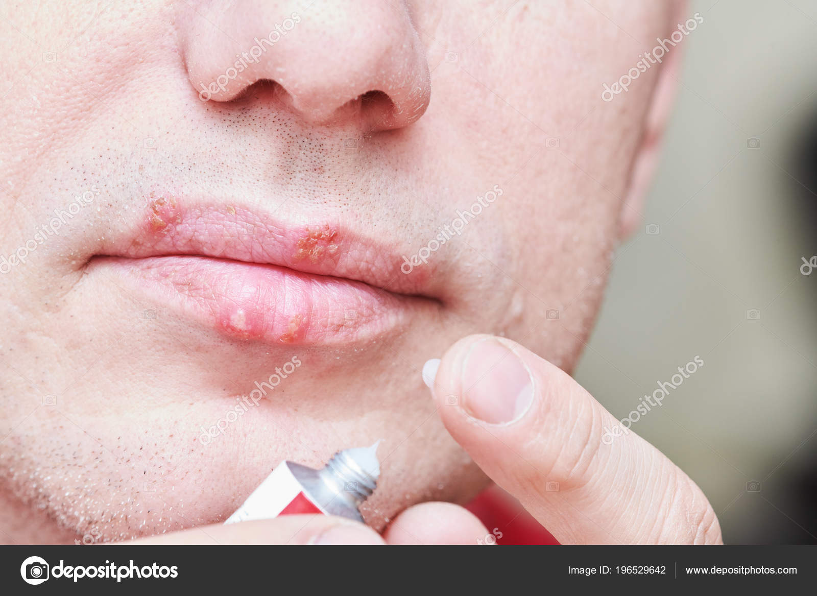 Herpes Simplex Virus Infektion Lippen Behandlung Von Cream