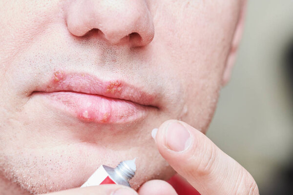 herpes simplex virus infection. Lips treatment by cream. Male face.