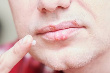Herpes simpleks virüs enfeksiyonu. Dudaklar krem ile tedavi. Erkek yüz.