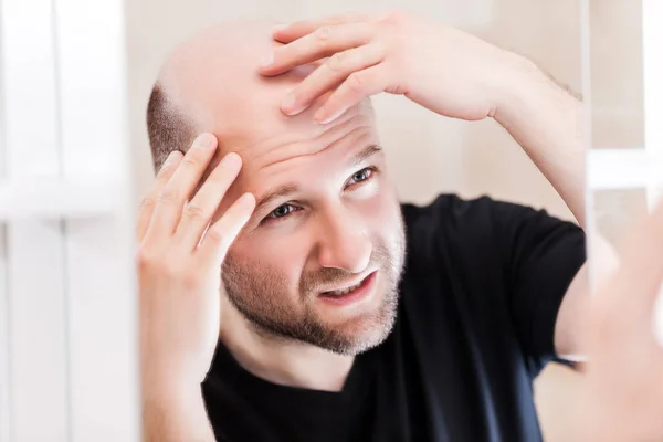 Maschio Alopecia Perdita Capelli Concetto Adulto Uomo Calvo Caucasico Cercando — Foto Stock