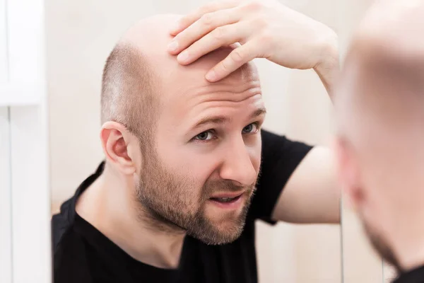 男性脱发或脱发的概念 成年白人秃头男子看镜头秃发治疗 — 图库照片