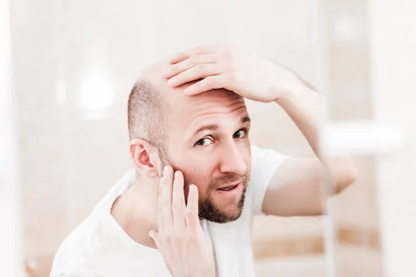 Male Alopecia Hair Loss Concept Adult Caucasian Bald Man Looking — Stock Photo, Image