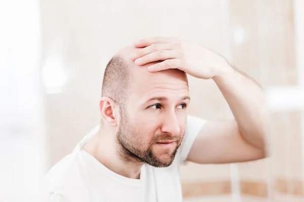 Mannelijke Alopecia Haar Verlies Concept Volwassen Kaukasische Kale Man Spiegel — Stockfoto