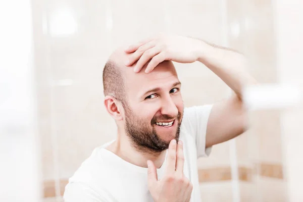 男性脱毛症または毛損失コンセプト アダルト白人のハゲの男性のミラーを探して頭のはげの治療薬 — ストック写真
