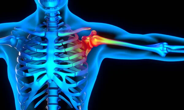 Schulterprobleme Und Schmerzen Medizin Und Gesundheit Darstellung — Stockfoto