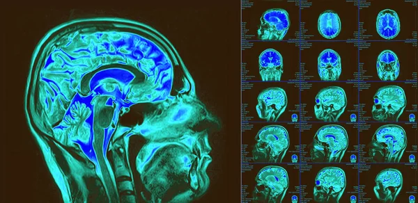 Magnetic resonance imaging of the brain. MRI scan — Stock Photo, Image