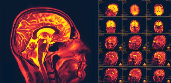 Magnetická rezonance mozku. MRI skenování — Stock fotografie