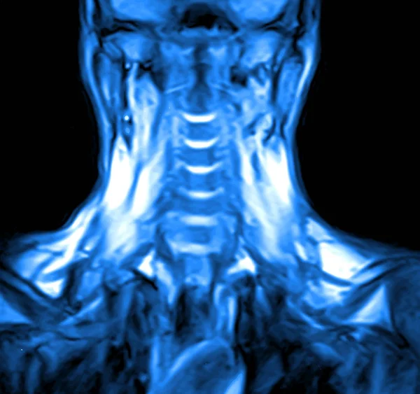 Magnetische resonantie beeldvorming van de cervicale wervelkolom. — Stockvector