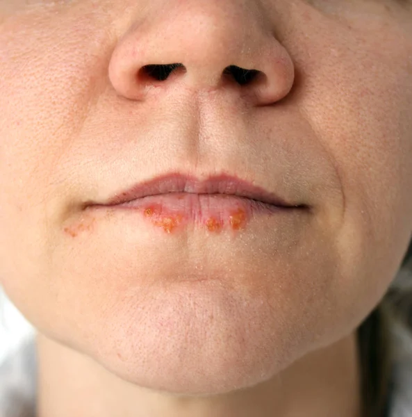 Forkjølelsessår Herpes Labialis Nært Foto – stockfoto