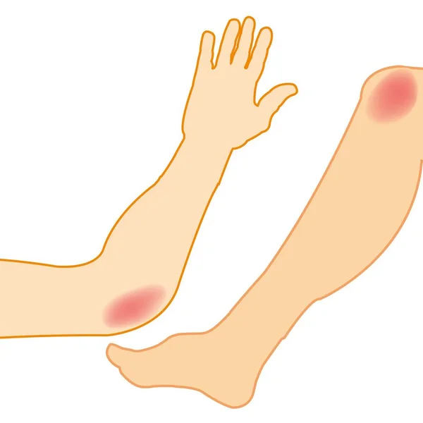 Schmerzen an Hand und Beinen — Stockvektor