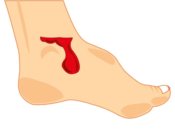 Ferita di sangue su gamba della persona — Vettoriale Stock