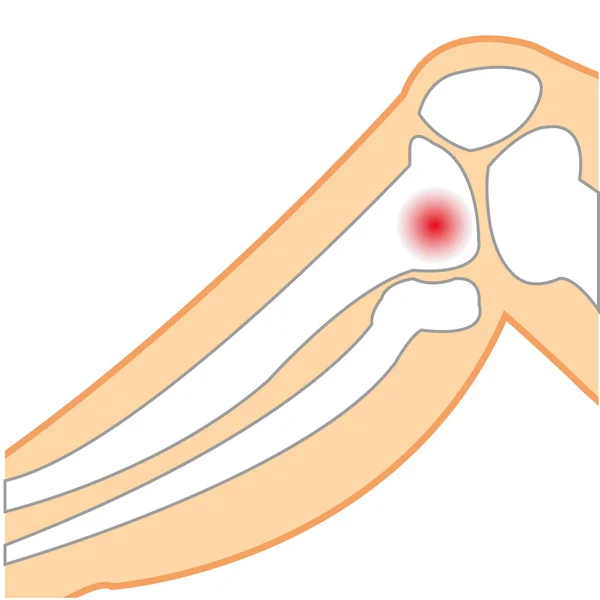 Векторна ілюстрація хворого коліна людини — стоковий вектор