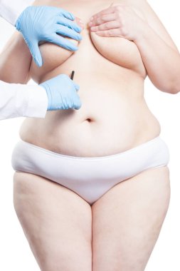 Plastik cerrahi için işaretleme şişman kadının karnında doktor. Kilo kaybı kavramı. (beyaz arka plan üzerinde izole)
