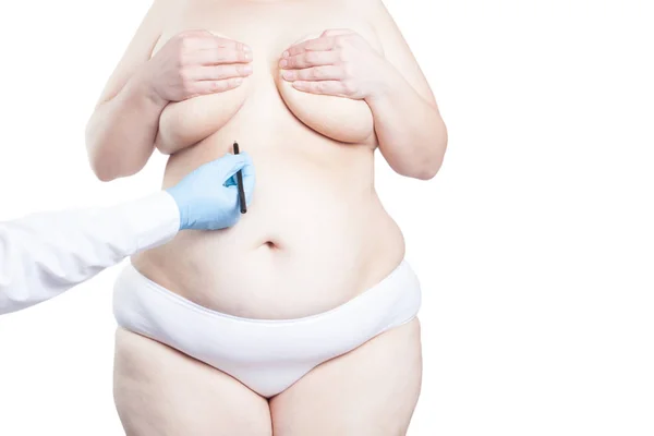Dokter Markering Stout Vrouw Buik Voor Plastische Chirurgie Gewichtsconcept Verlies Stockfoto