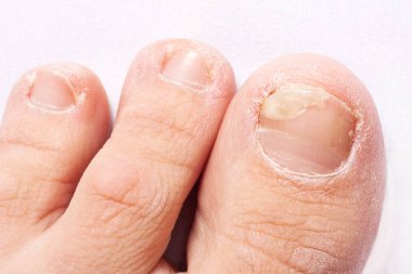 fungal nail infection (Onychomycosis). dry coarse skin of the legs (eczema) clipart