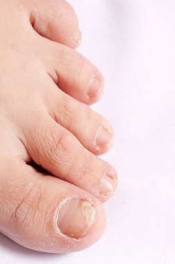 tırnak mantar enfeksiyonu (Onikomikoz). bacak (egzama kuru kaba cilt)