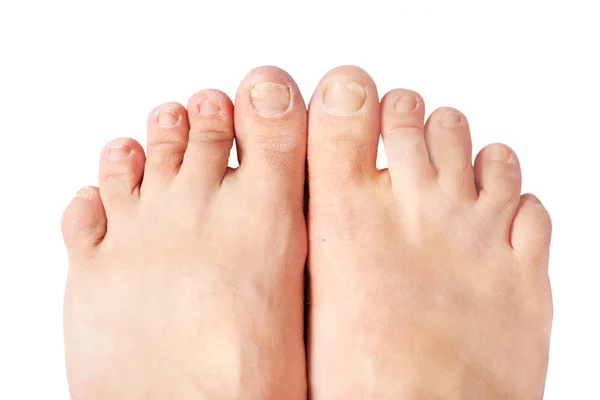 Infekce Mykotických Nehtů Onychomykóza Suchou Hrubou Pokožku Nohou Ekzém — Stock fotografie
