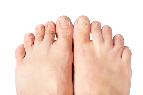 Schimmel Nagel Infecties Onychomycosis Droge Grof Huid Van Benen Eczeem — Stockfoto