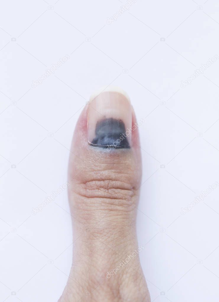 Subungual Hematoma on thumb female's finger over white studio background. 