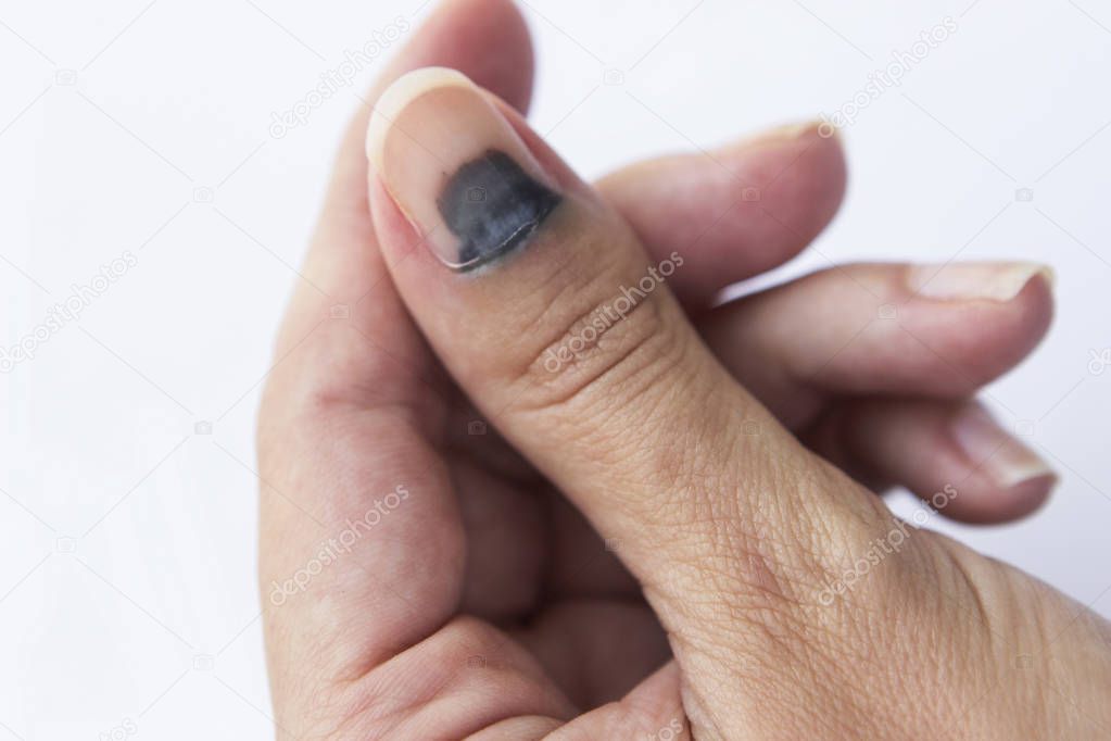 Subungual Hematoma on thumb nail on white background.