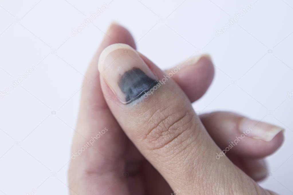 Horizontal shot of bruised thumb finger with subungual hematoma.