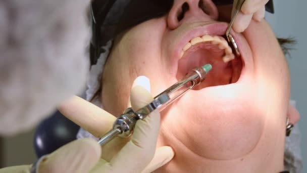Старша жінка отримує імплантат зубів — стокове відео