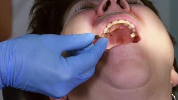 Yaşlı kadın diş implantı yaptırıyor. — Stok video