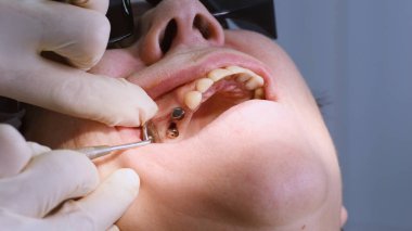 Yaşlı kadın diş implantı yaptırıyor.