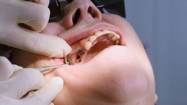 Mulher idosa recebendo implantes dentários — Fotografia de Stock